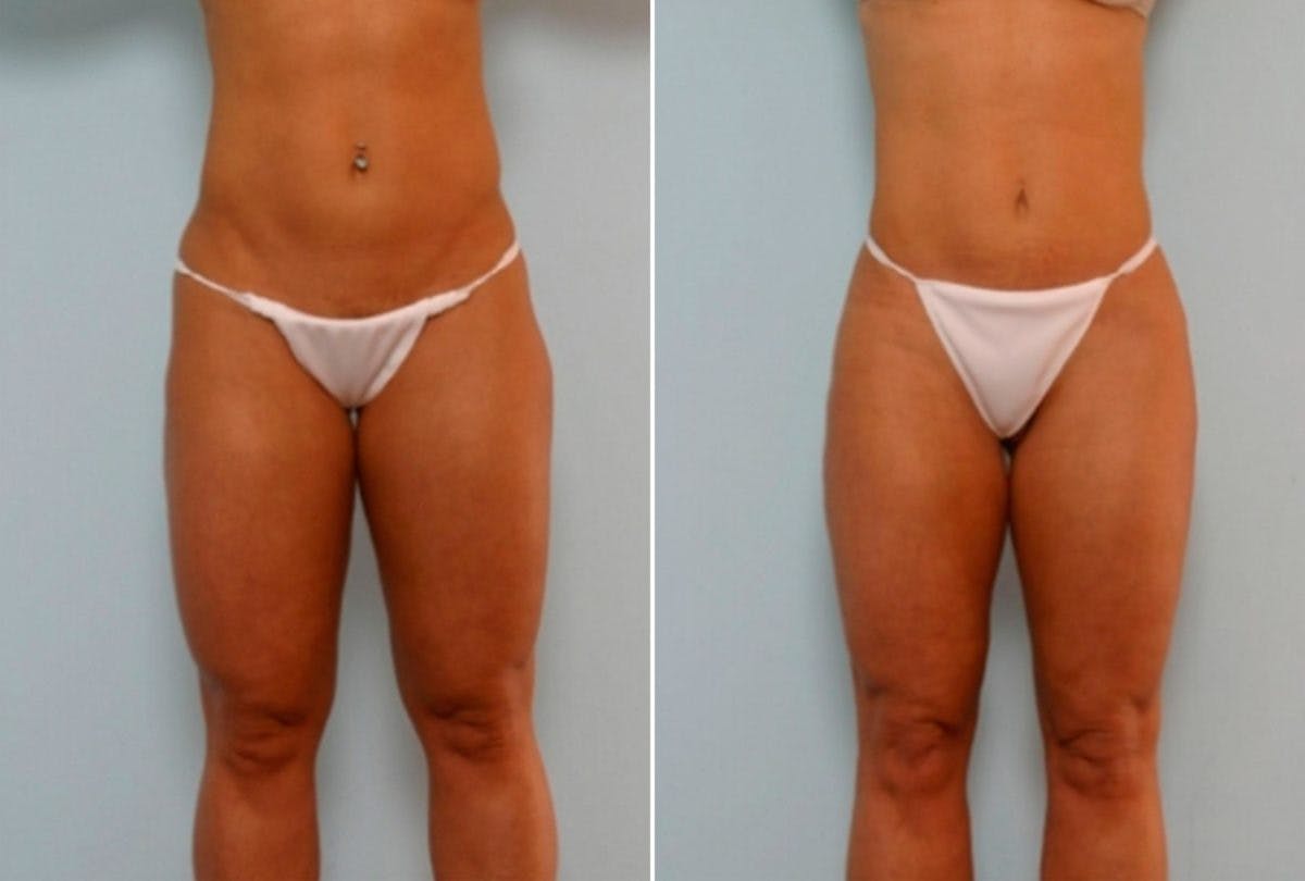 Butt Augmentation Before & After Photo - Patient 54882274 - Image 2