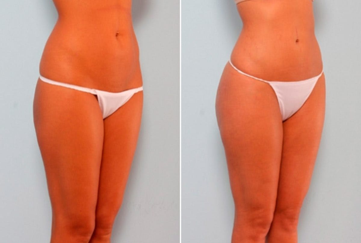 Butt Augmentation Before & After Gallery - Patient 54882276 - Image 3