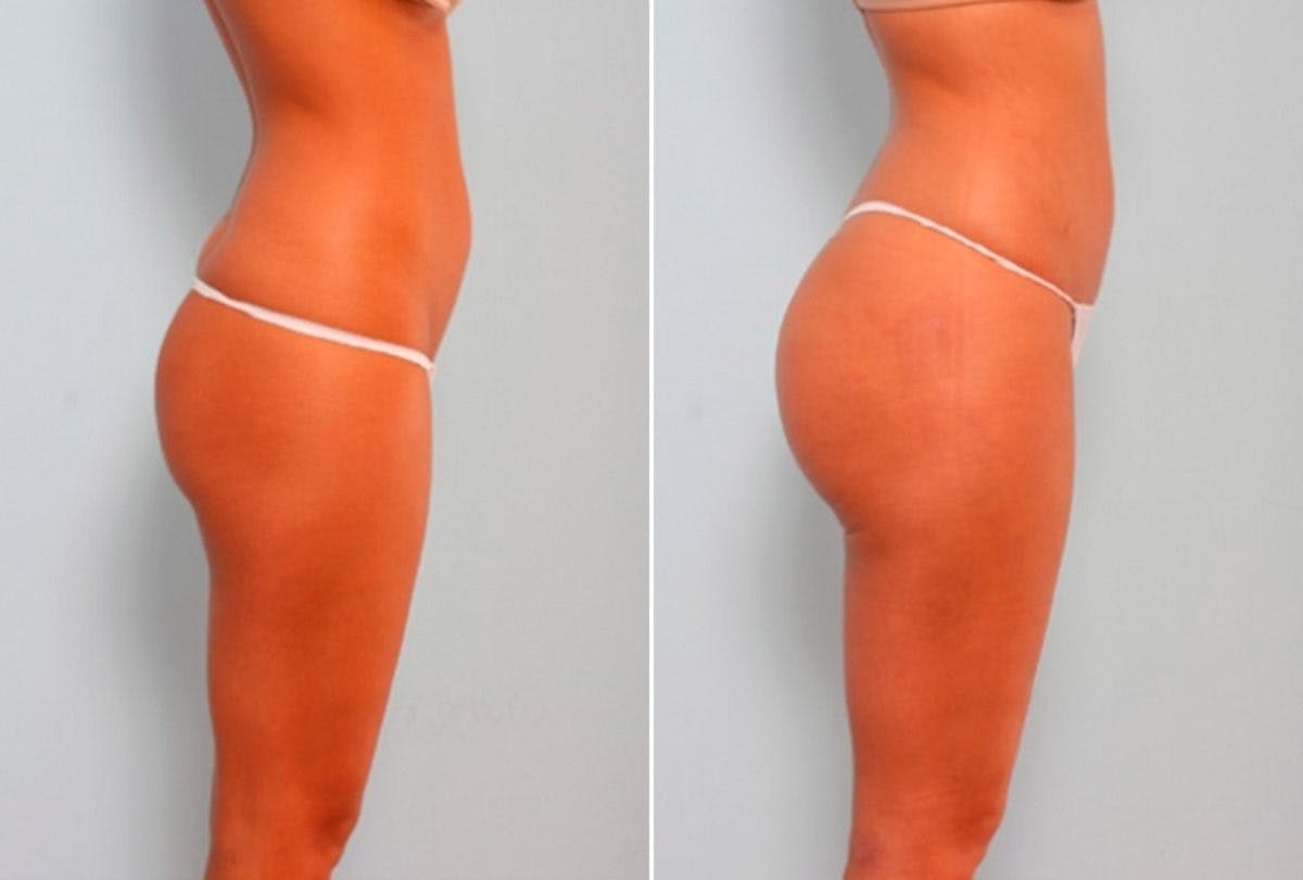 Butt Augmentation Before & After Photo - Patient 54882276 - Image 4