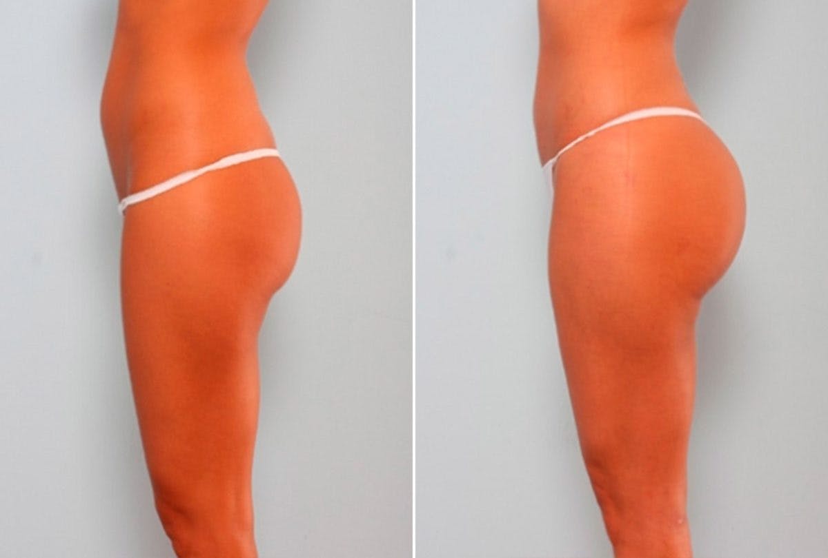 Butt Augmentation Before & After Gallery - Patient 54882276 - Image 6