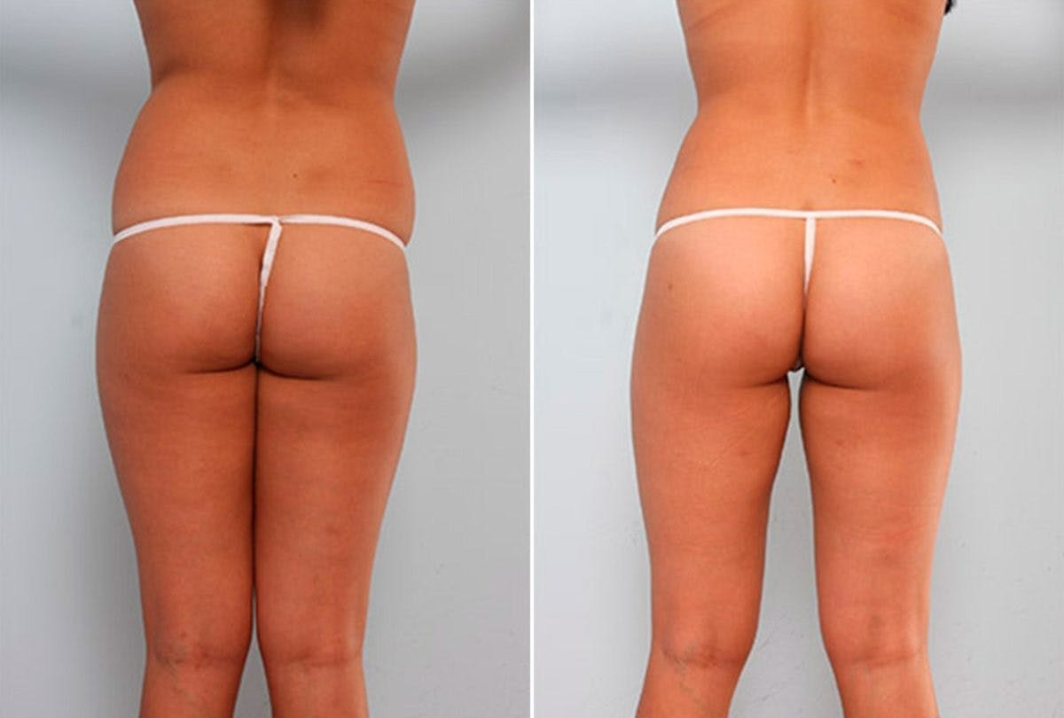 Butt Augmentation Before & After Gallery - Patient 54882277 - Image 1