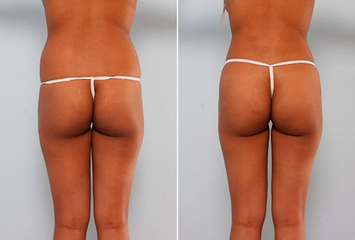Butt Augmentation Before & After Gallery - Patient 54882278 - Image 1