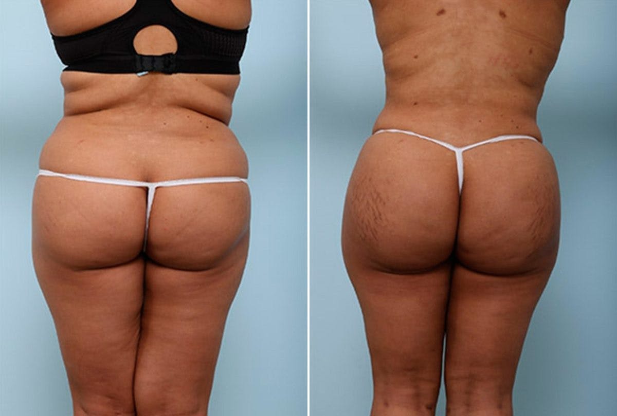 Butt Augmentation Before & After Gallery - Patient 54882279 - Image 1