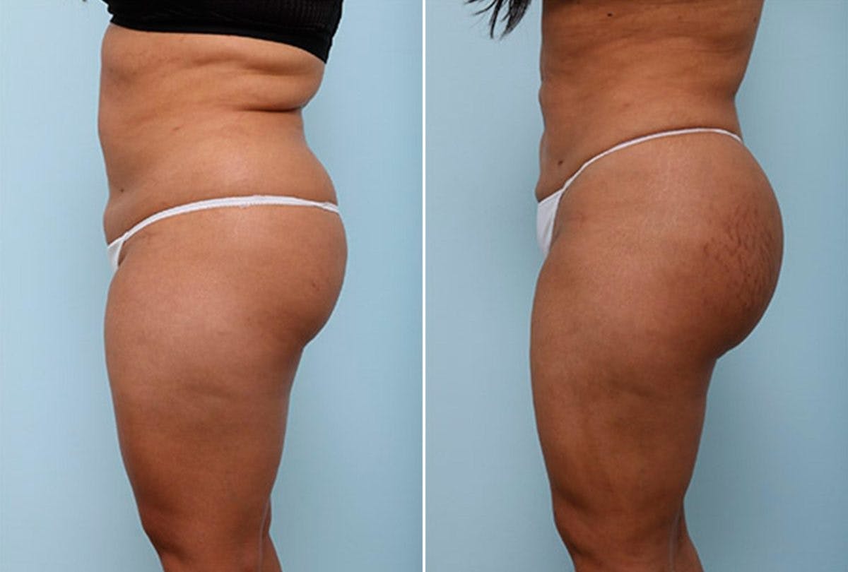 Butt Augmentation Before & After Photo - Patient 54882279 - Image 3