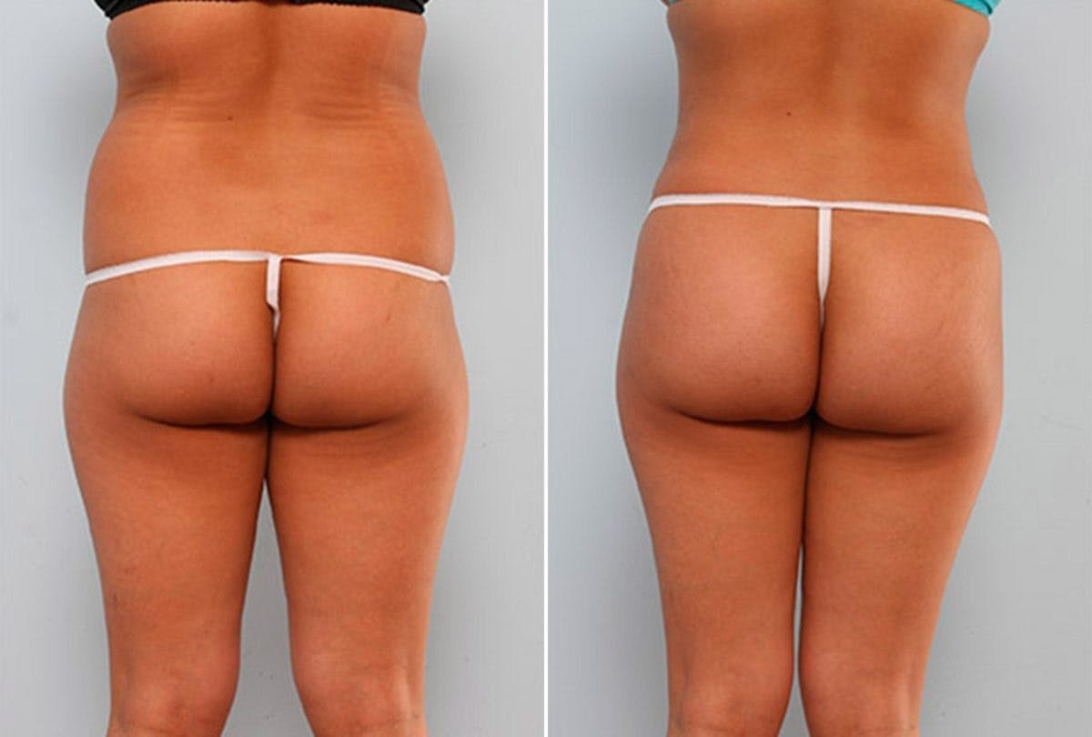 Butt Augmentation Before & After Gallery - Patient 54882280 - Image 1