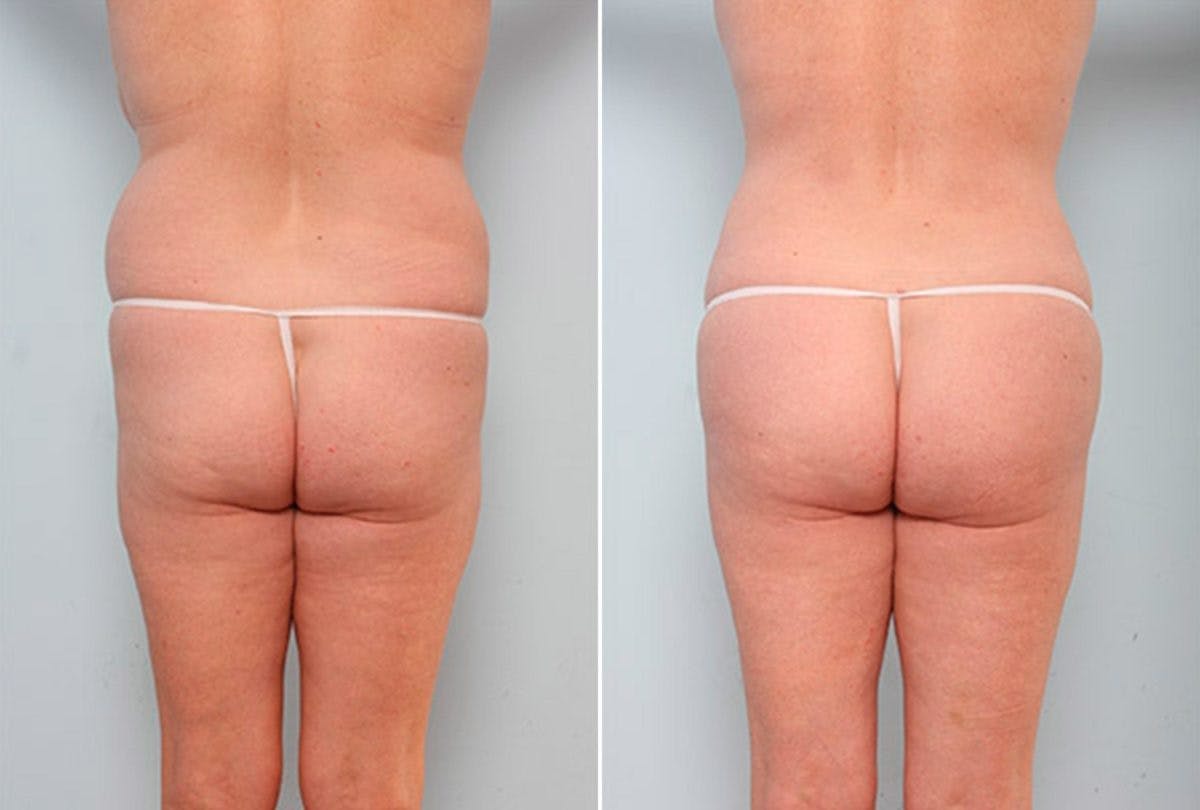 Butt Augmentation Before & After Gallery - Patient 54882281 - Image 1