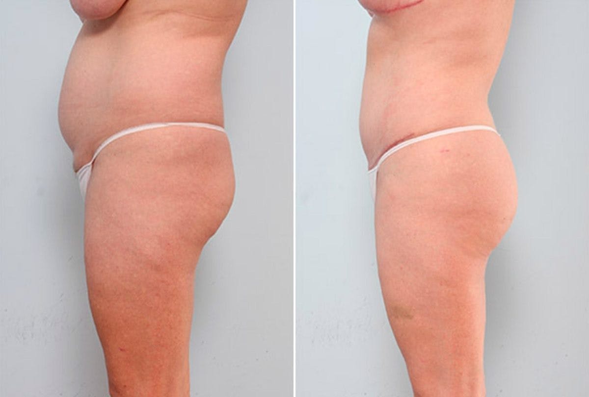 Butt Augmentation Before & After Gallery - Patient 54882281 - Image 3
