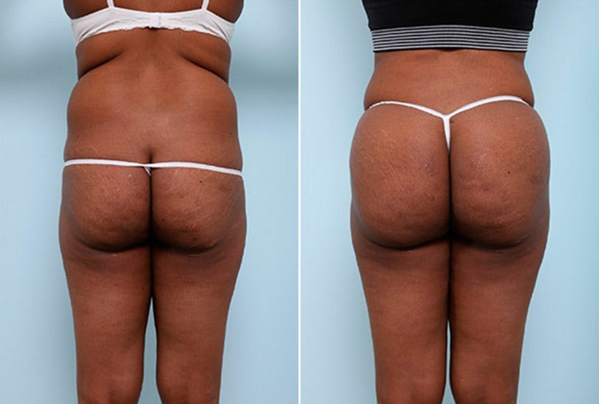 Butt Augmentation Before & After Gallery - Patient 54882282 - Image 1