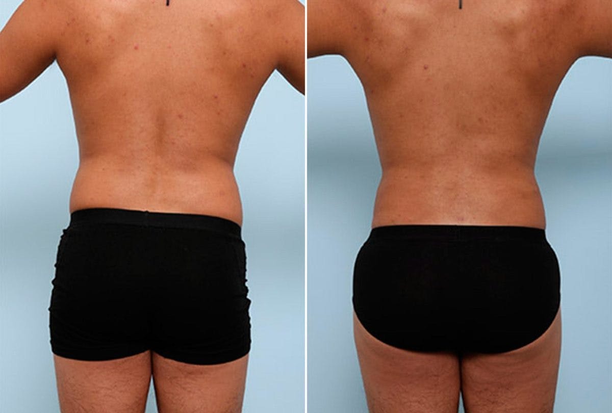 Butt Augmentation Before & After Gallery - Patient 54882284 - Image 1