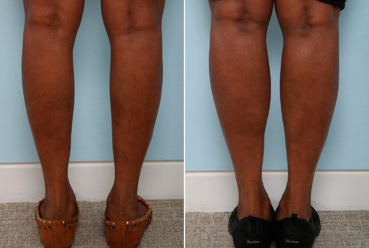 Calf Implants Before & After Gallery - Patient 54882293 - Image 1