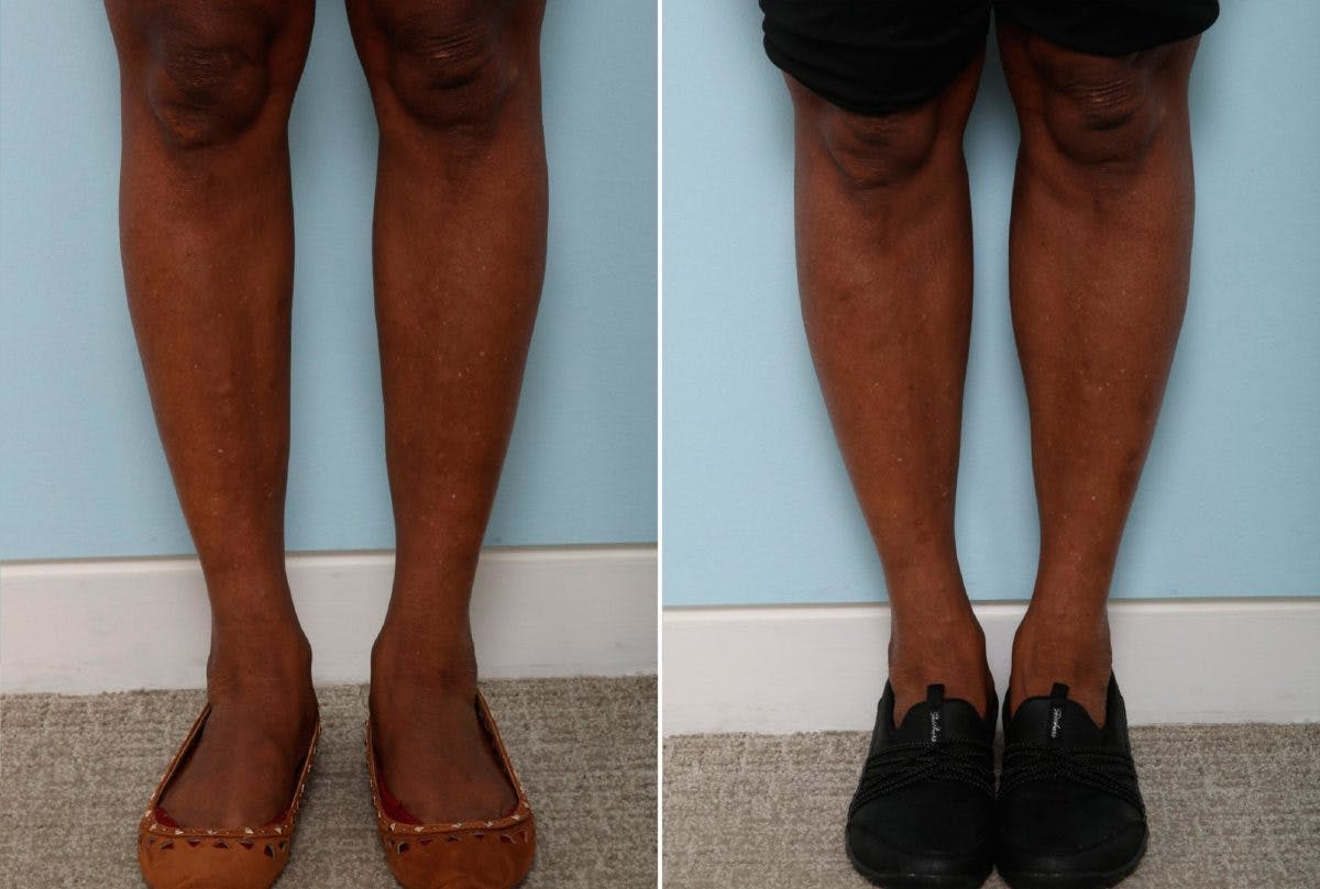 Calf Implants Before & After Gallery - Patient 54882293 - Image 2