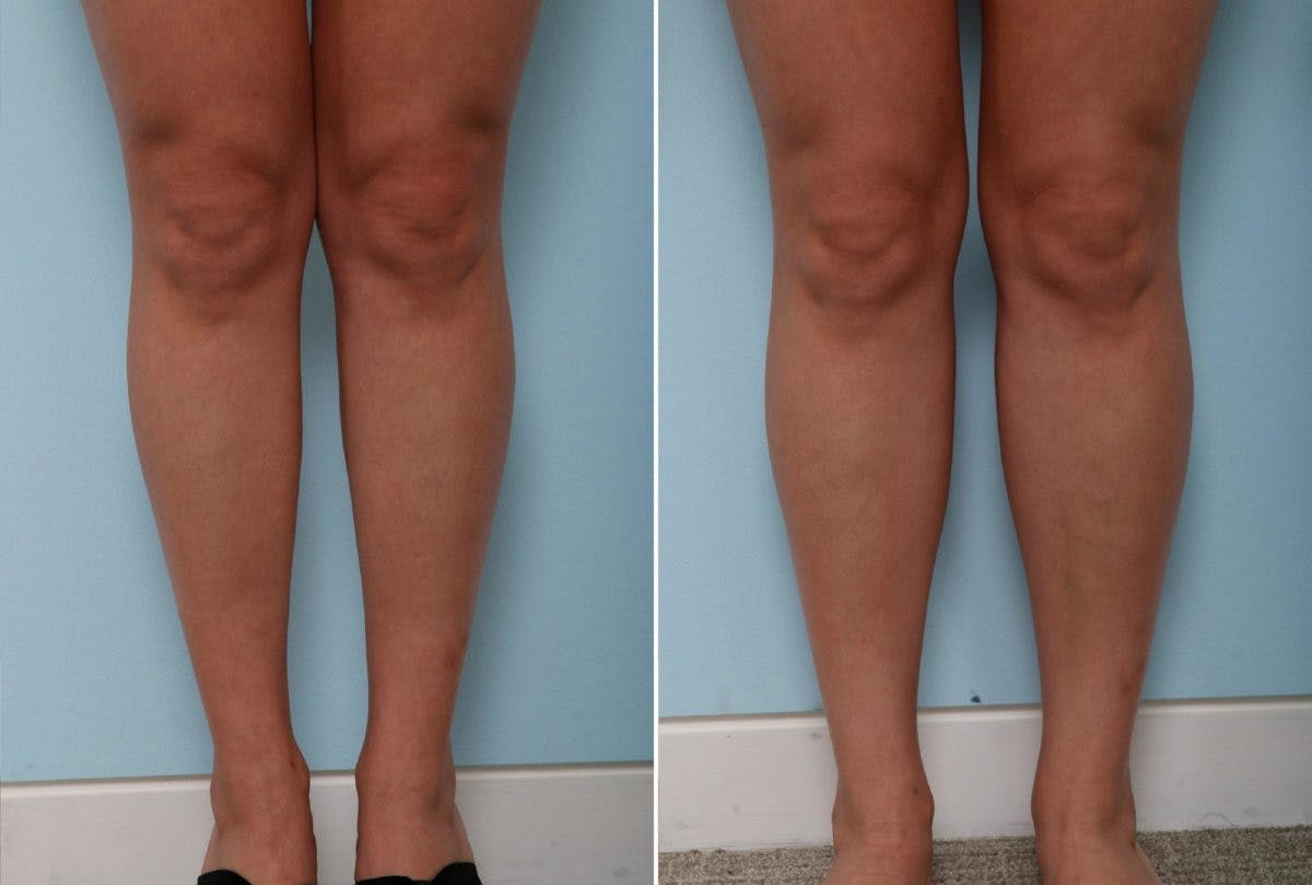 Calf Implants Before & After Photo - Patient 54882294 - Image 2