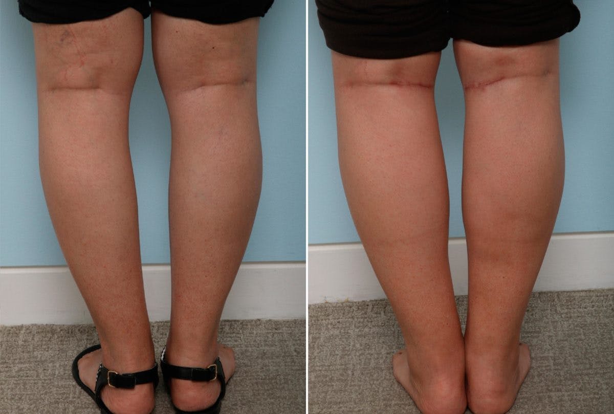 Calf Implants Before & After Gallery - Patient 54882299 - Image 1