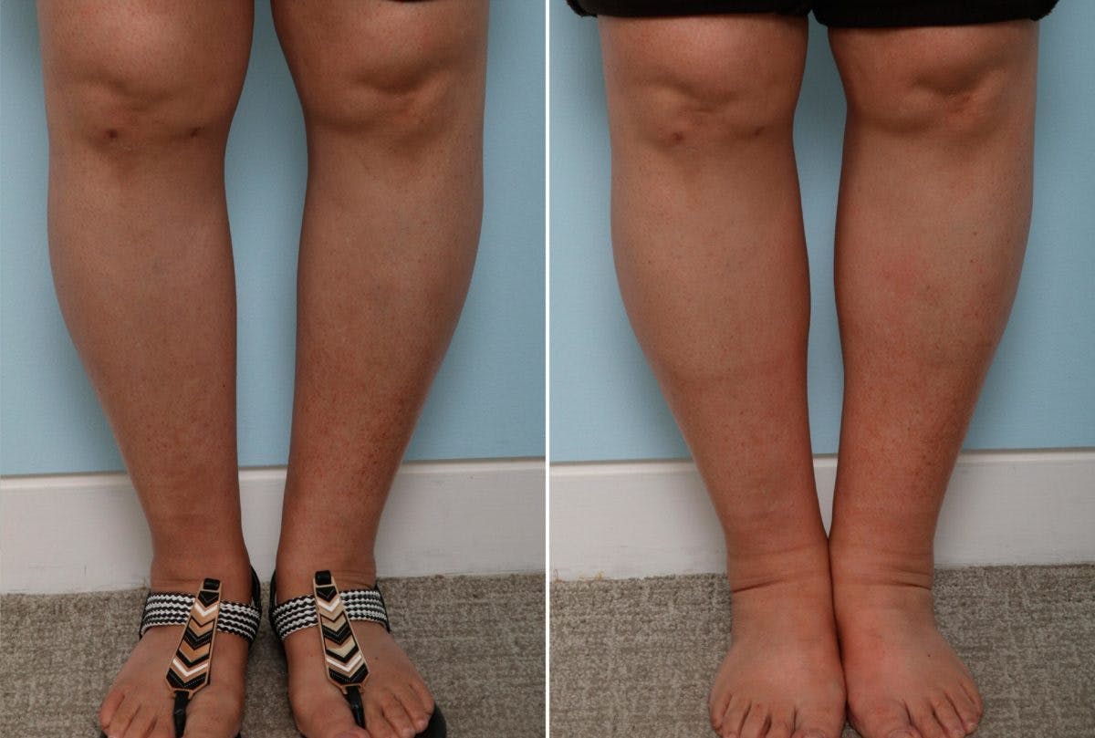 Calf Implants Before & After Photo - Patient 54882299 - Image 2