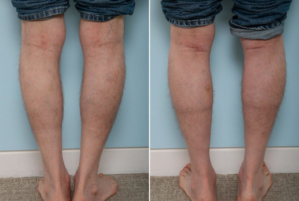 Calf Implants Before & After Photo - Patient 54882300 - Image 1