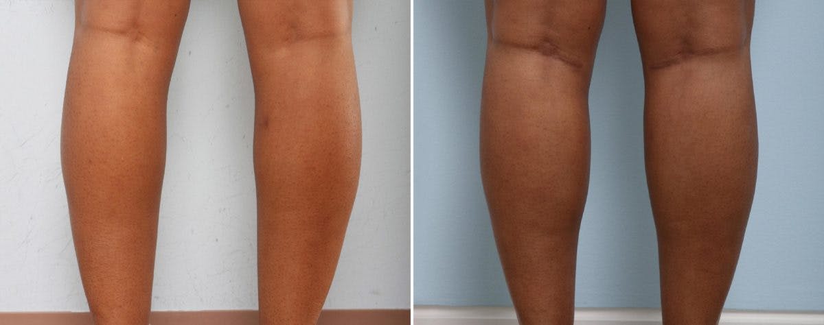 Calf Implants Before & After Gallery - Patient 54882301 - Image 1