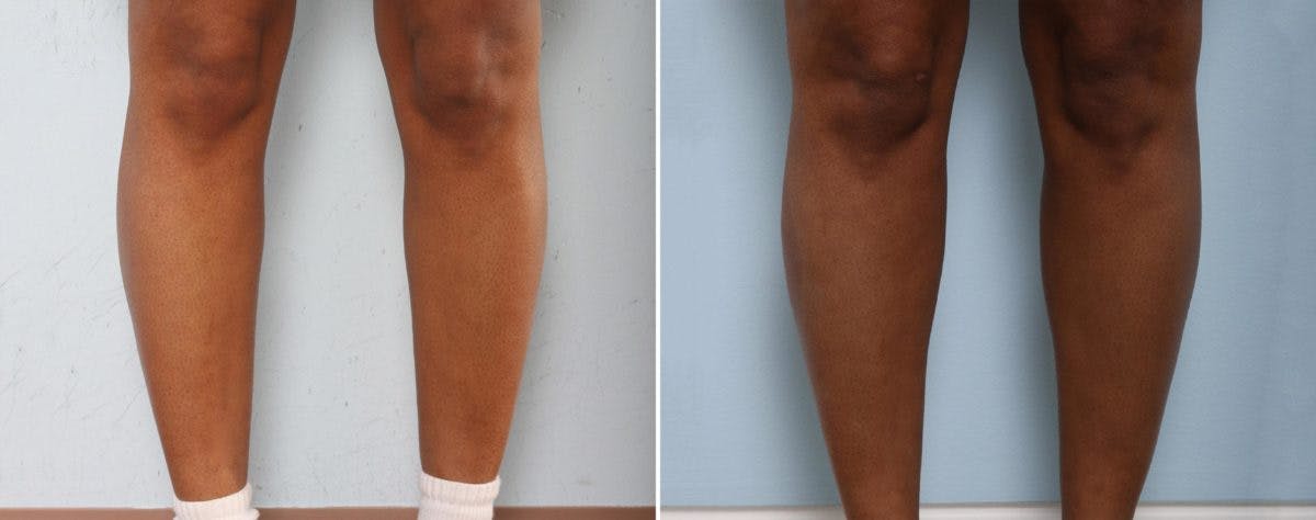 Calf Implants Before & After Gallery - Patient 54882301 - Image 2