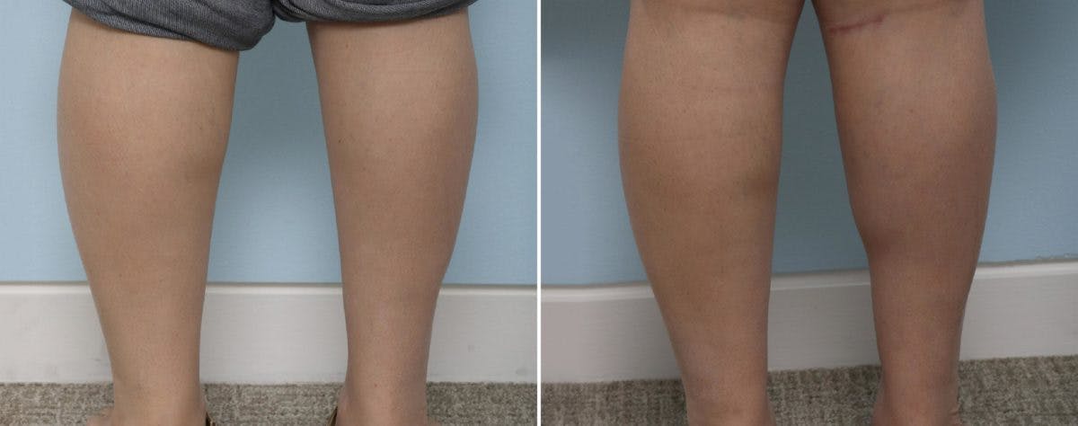 Calf Implants Before & After Photo - Patient 54882303 - Image 1