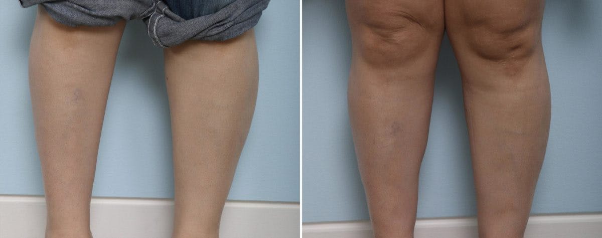 Calf Implants Before & After Photo - Patient 54882303 - Image 2