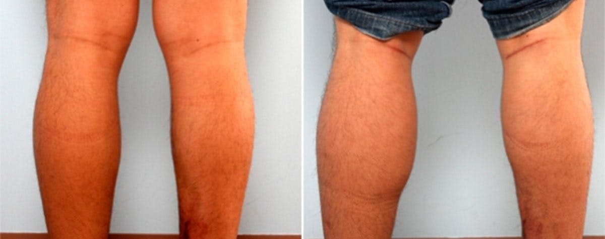 Calf Implants Before & After Gallery - Patient 54882304 - Image 1