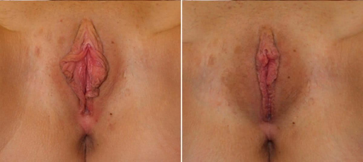 Labiaplasty Before & After Gallery - Patient 54882336 - Image 1