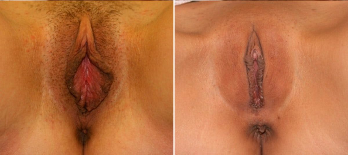 Labiaplasty Before & After Photo - Patient 54882337 - Image 1