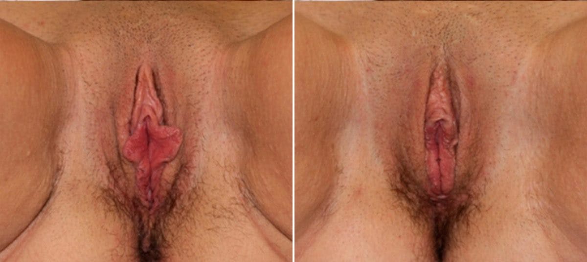 Labiaplasty Before & After Gallery - Patient 54882341 - Image 1