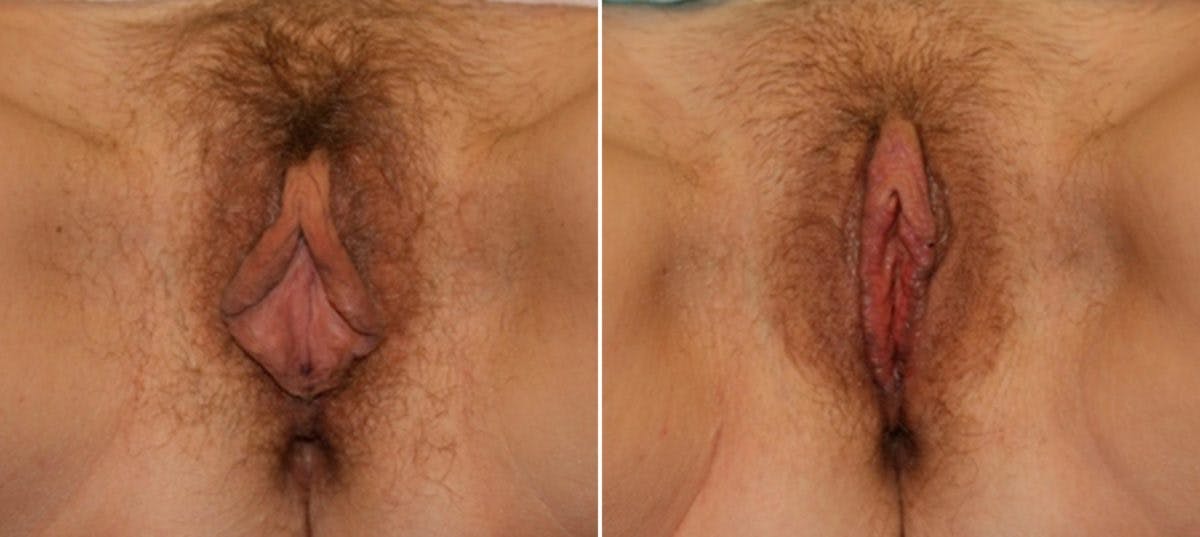 Labiaplasty Before & After Photo - Patient 54882343 - Image 1