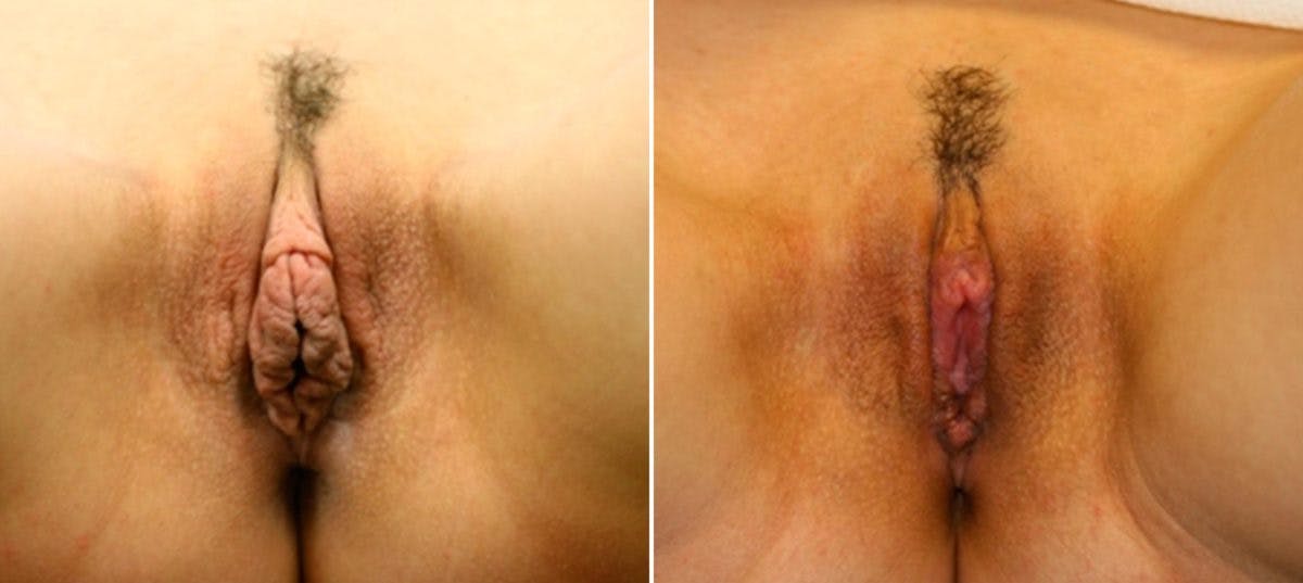Labiaplasty Before & After Gallery - Patient 54882347 - Image 1