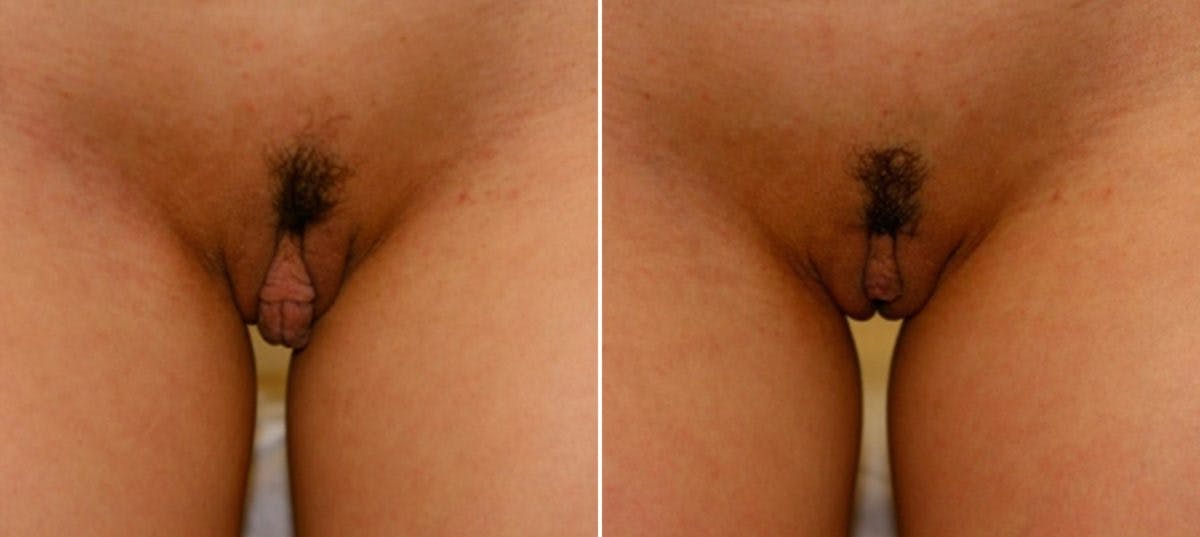 Labiaplasty Before & After Gallery - Patient 54882347 - Image 2