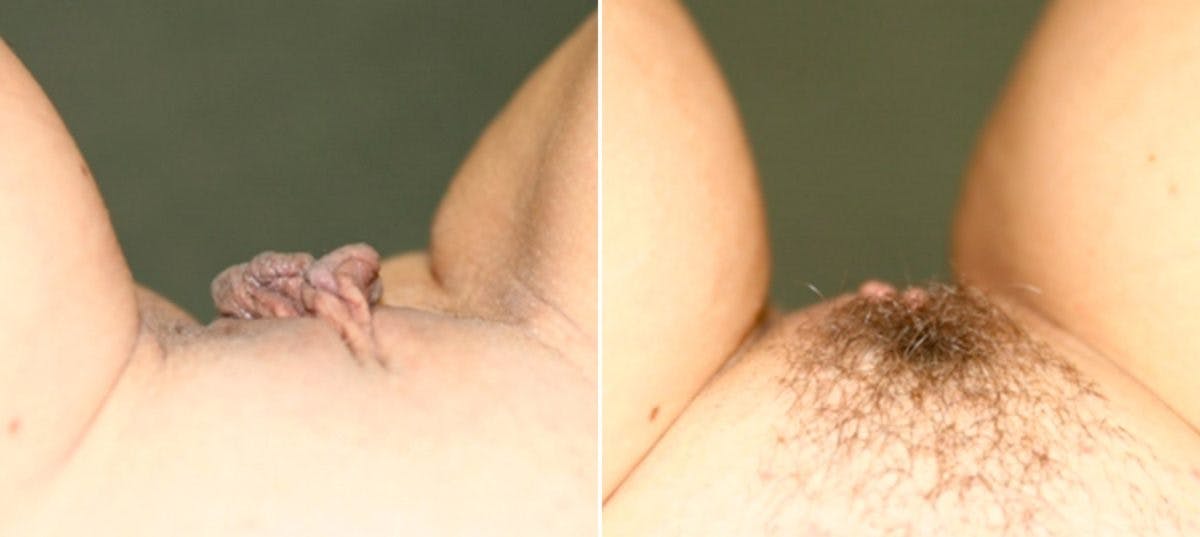 Labiaplasty Before & After Gallery - Patient 54882348 - Image 2
