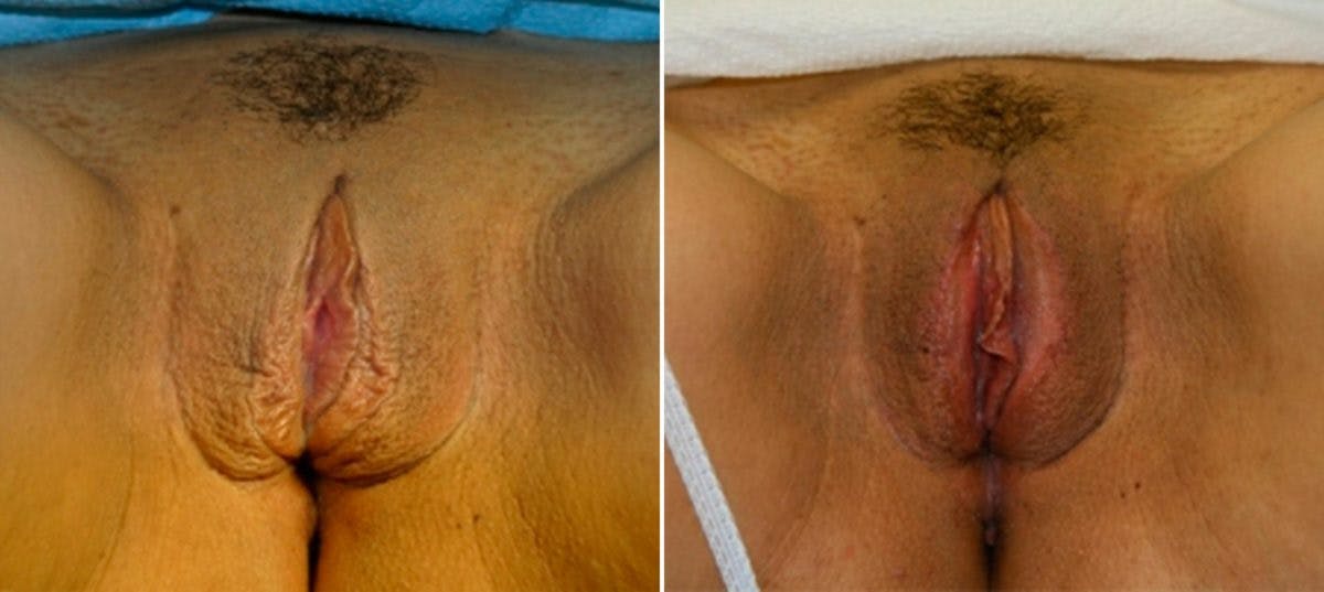 Labiaplasty Before & After Photo - Patient 54882352 - Image 1
