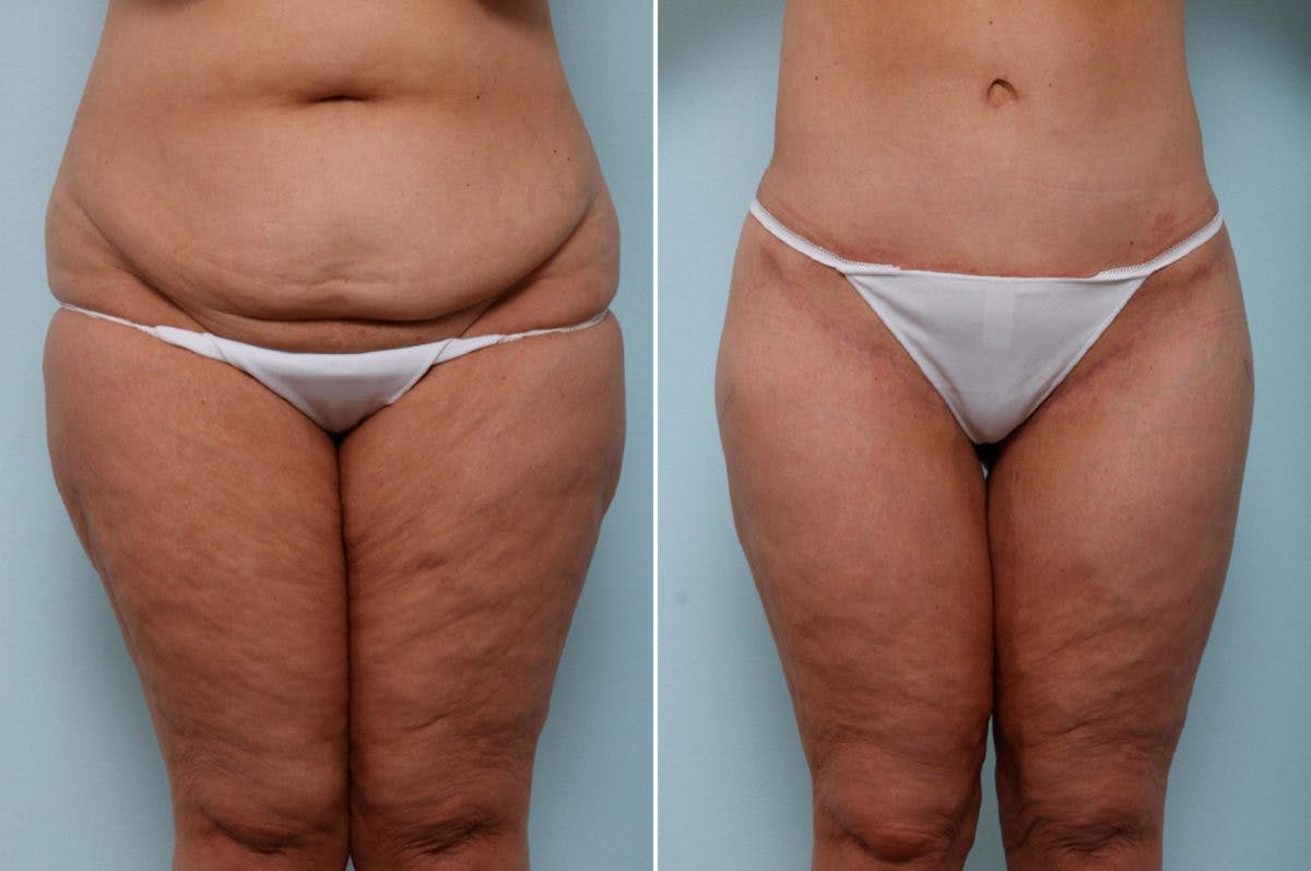 Thigh Lift Before & After Photo - Patient 54882372 - Image 2