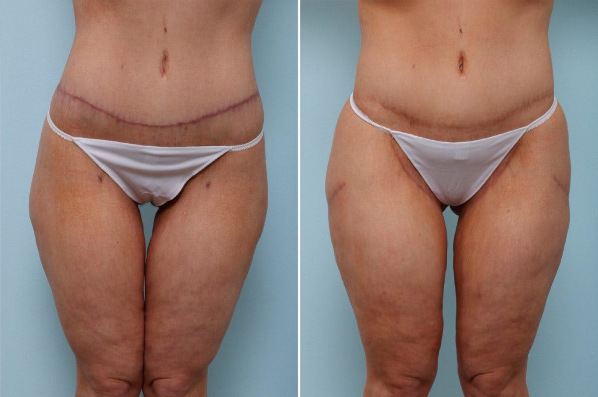 Thigh Lift Before & After Gallery - Patient 54882375 - Image 2