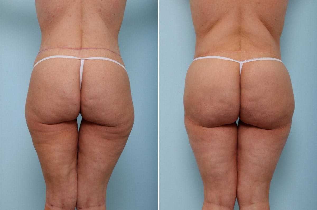 Thigh Lift Before & After Gallery - Patient 54882375 - Image 1