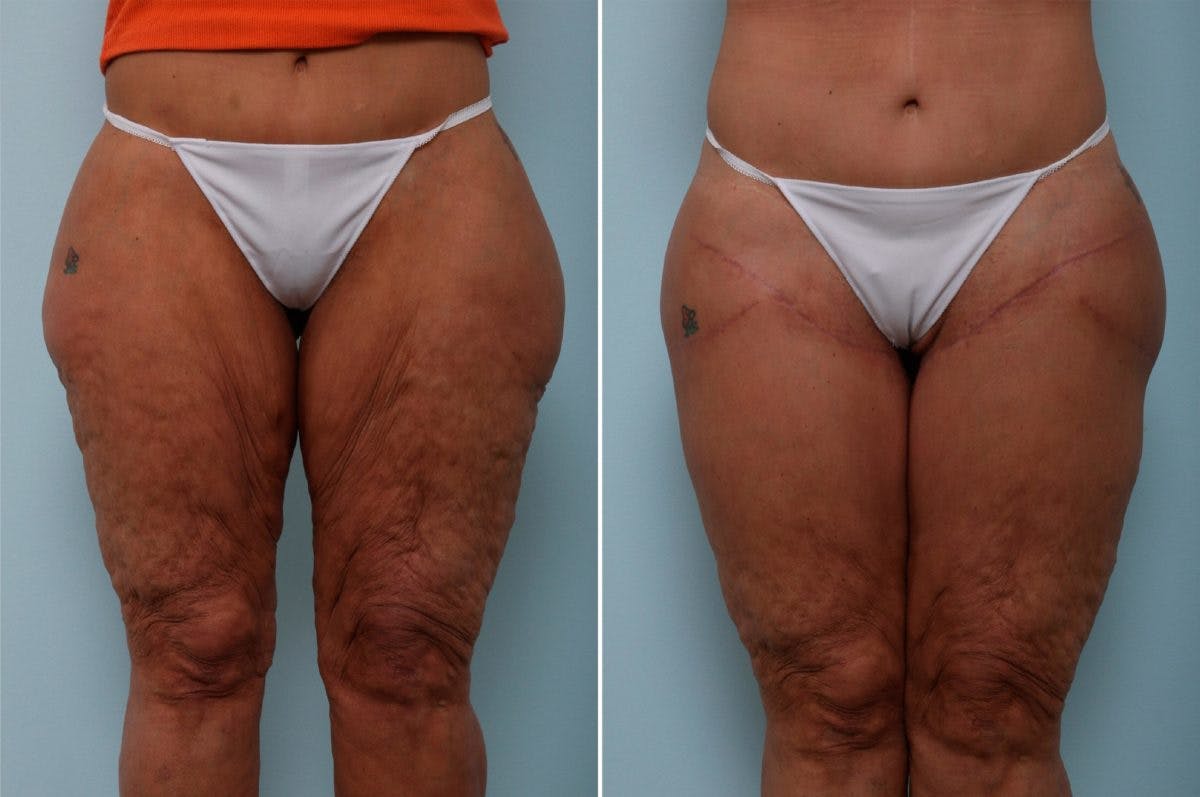 Thigh Lift Before & After Photo - Patient 54882376 - Image 2