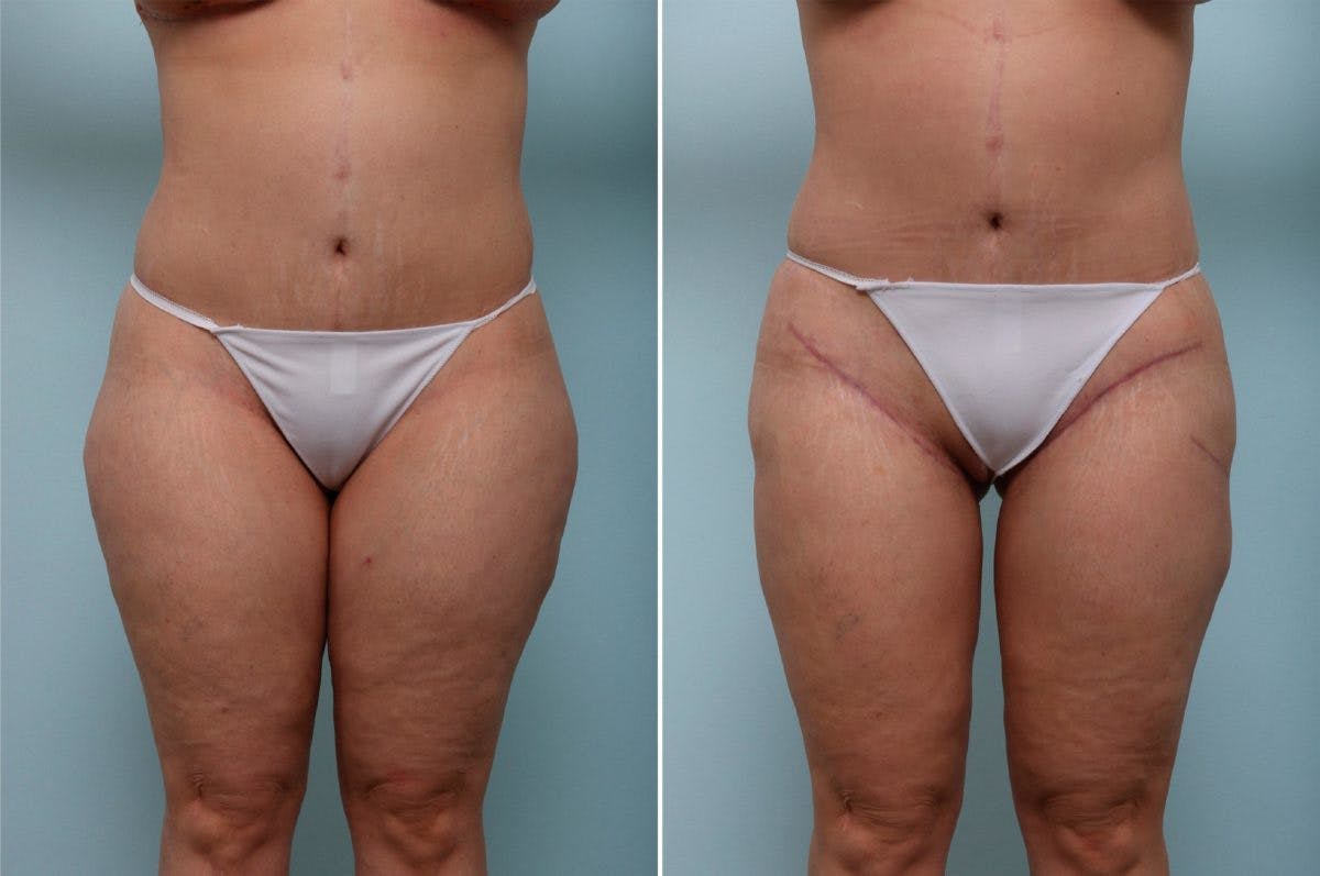 Thigh Lift Before & After Gallery - Patient 54882377 - Image 2