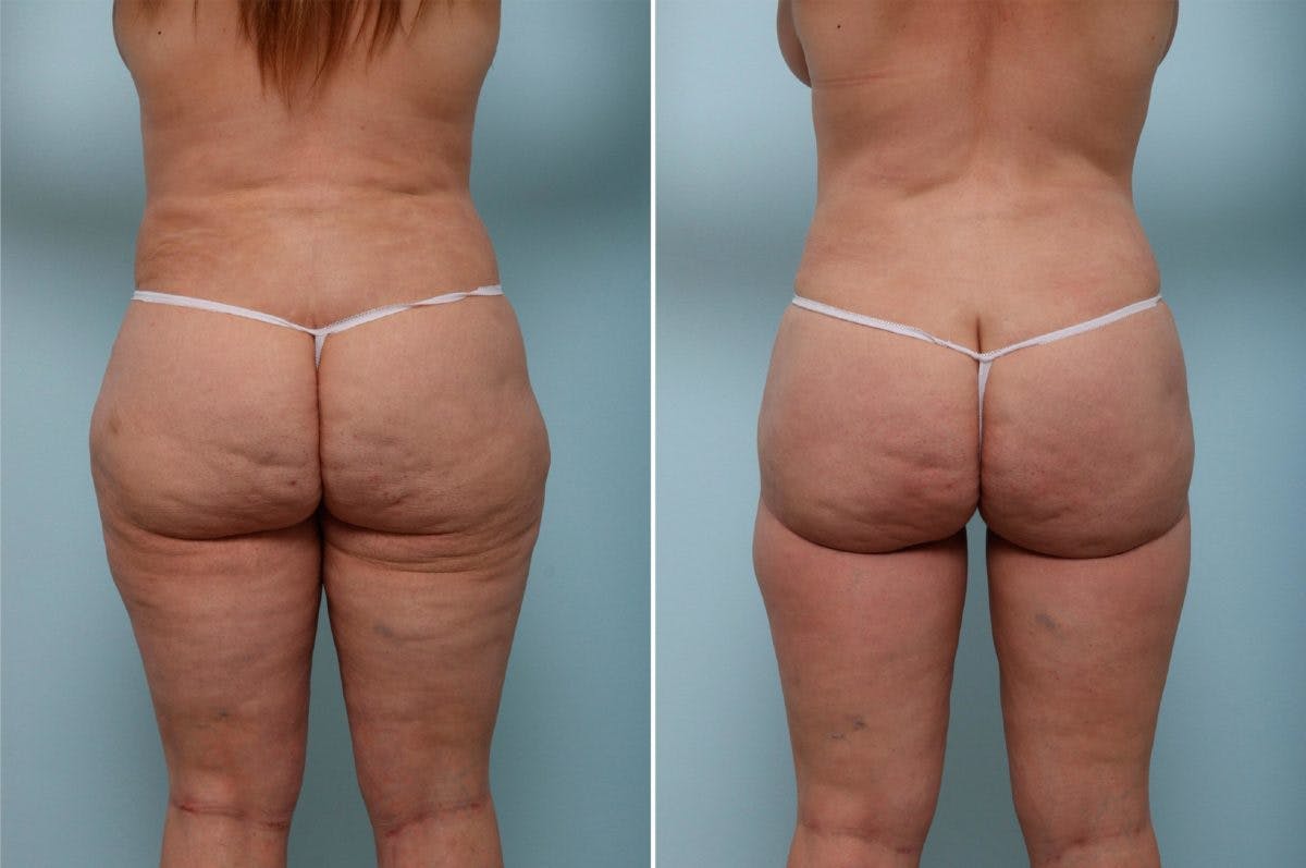Thigh Lift Before & After Photo - Patient 54882377 - Image 1