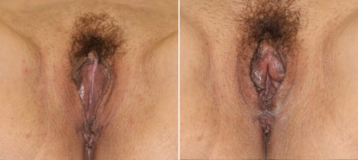 Vaginoplasty Before & After Gallery - Patient 54882712 - Image 1