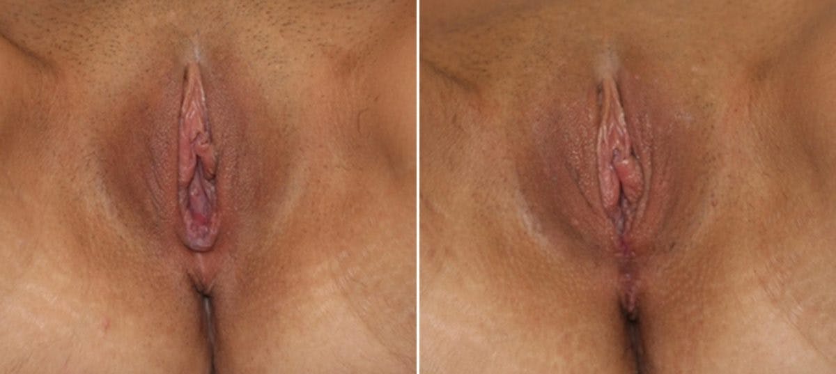 Vaginoplasty Before & After Gallery - Patient 54882714 - Image 1