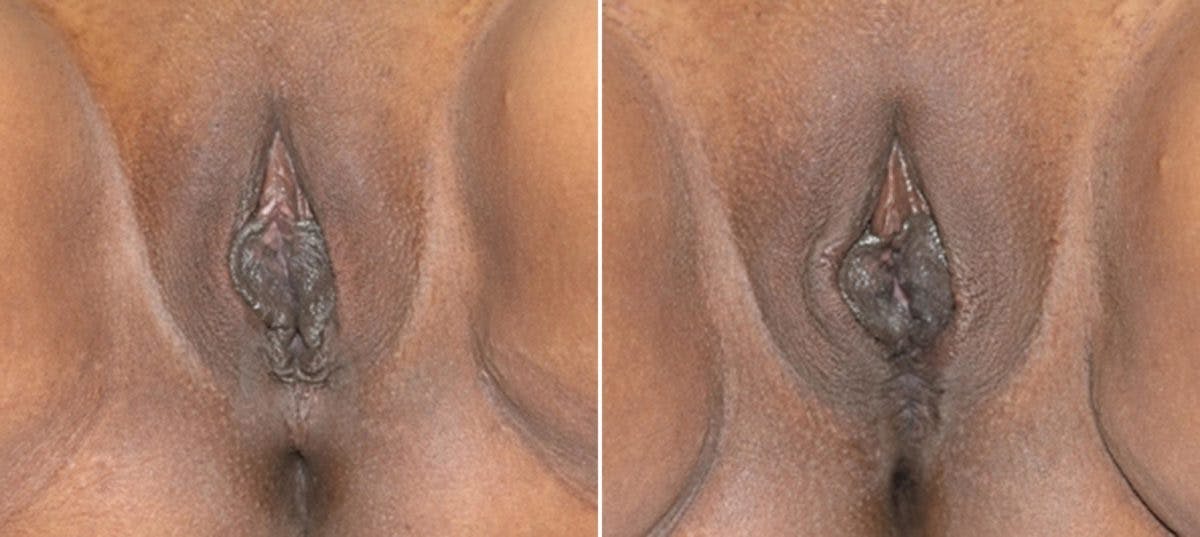 Vaginoplasty Before & After Gallery - Patient 54882720 - Image 1