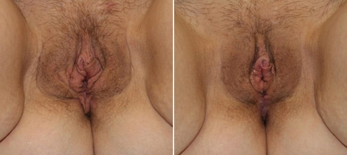 Vaginoplasty Before & After Photo - Patient 54882721 - Image 1