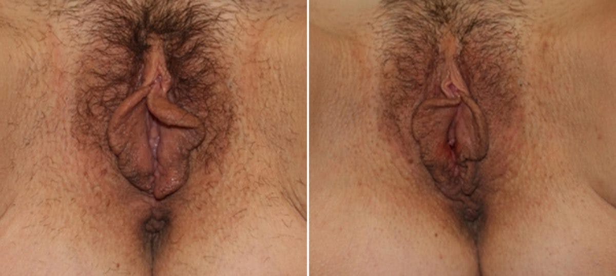 Vaginoplasty Before & After Gallery - Patient 54882726 - Image 1