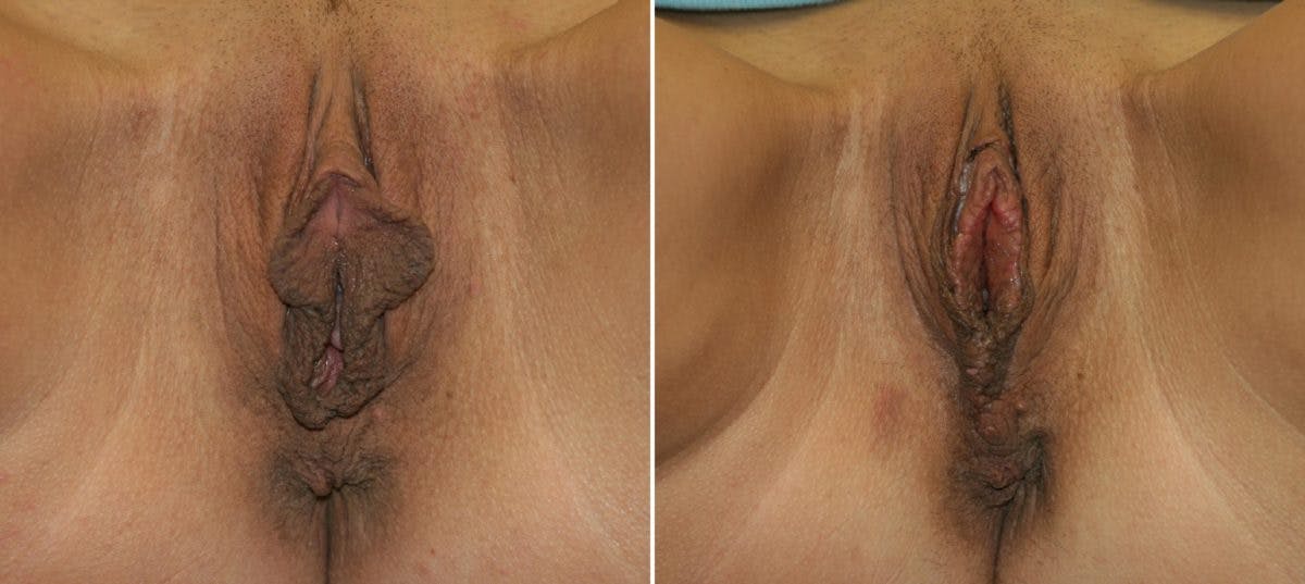 Vaginoplasty Before & After Gallery - Patient 54882731 - Image 1