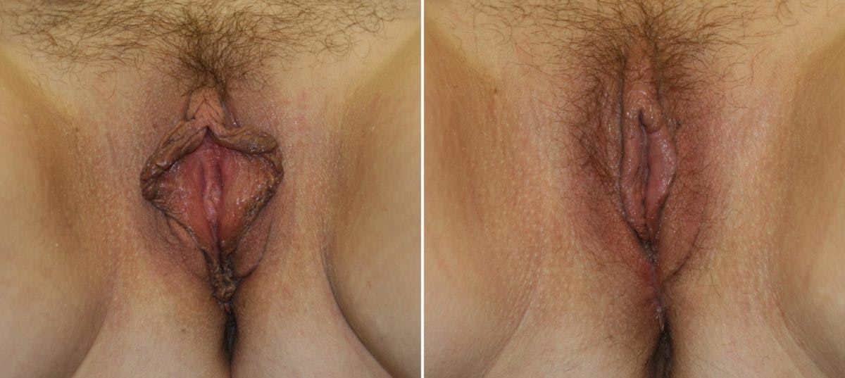 Vaginoplasty Before & After Gallery - Patient 54882734 - Image 1