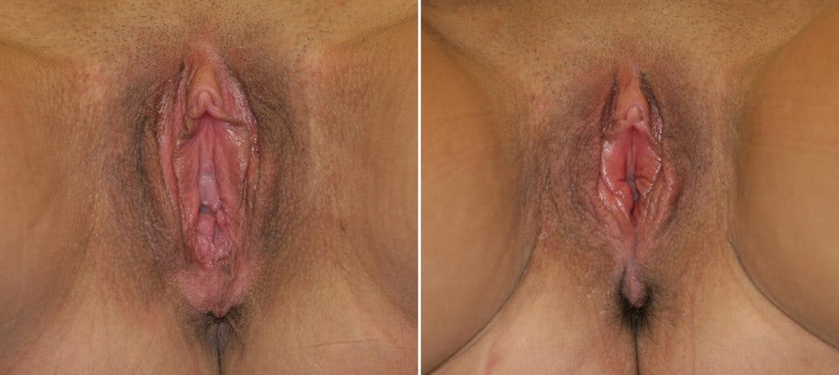 Vaginoplasty Before & After Gallery - Patient 54882735 - Image 1