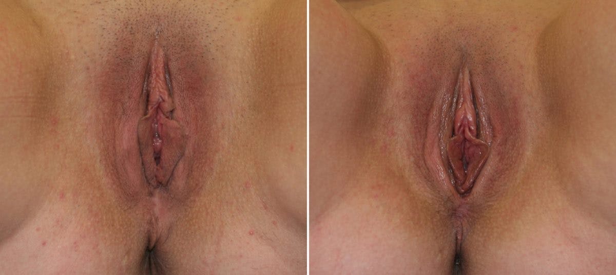 Vaginoplasty Before & After Gallery - Patient 54882740 - Image 1