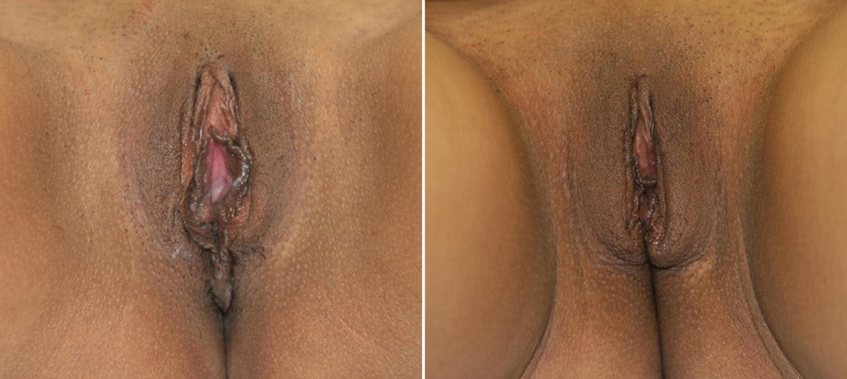 Vaginoplasty Before & After Gallery - Patient 54882741 - Image 1