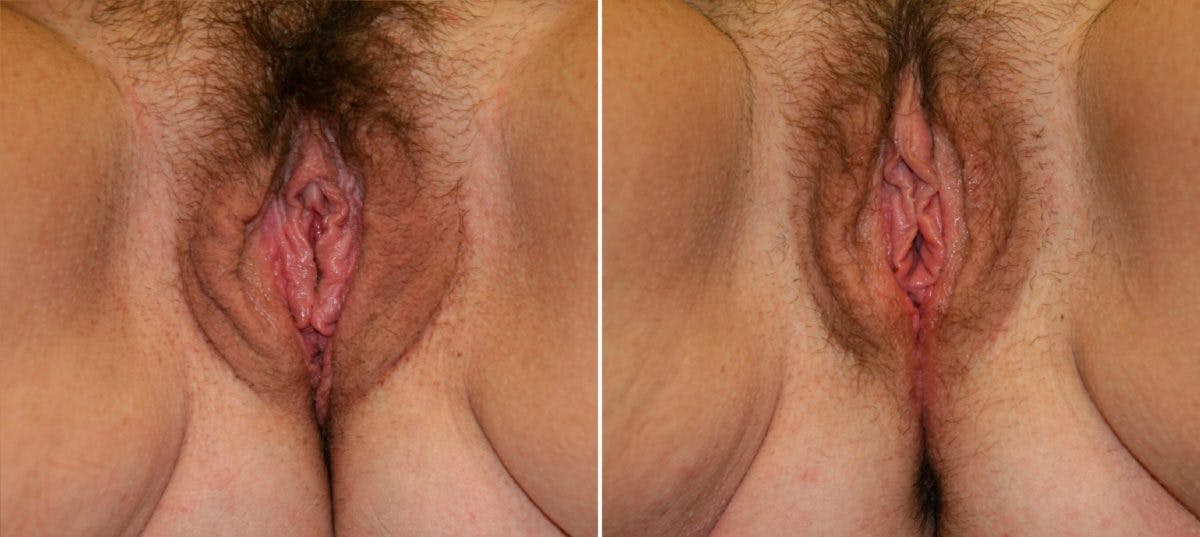 Vaginoplasty Before & After Gallery - Patient 54882744 - Image 1