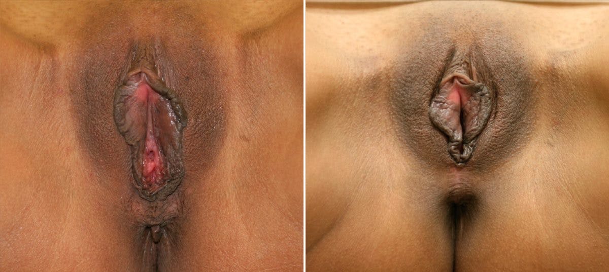 Vaginoplasty Before & After Photo - Patient 54882745 - Image 1